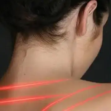 Laser therapy in Denver