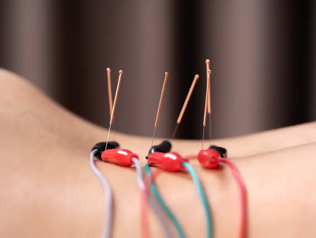 electroacupuncture for back pain