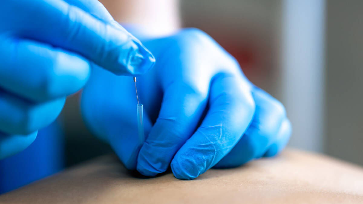 Acupuncture for pain relief in Denver
