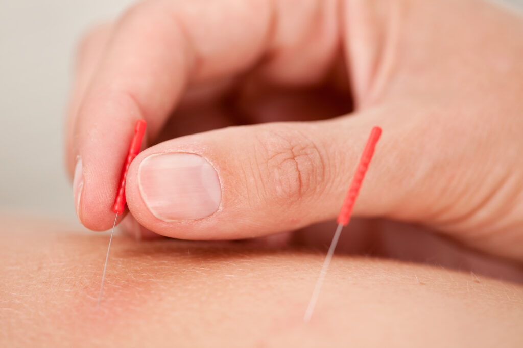 Acupuncture vs Dry Needling